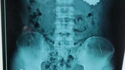 Seorang Warga Pemakan Paku Dari Indramayu Diselamatkan Oleh Tim Dokter Bedah
